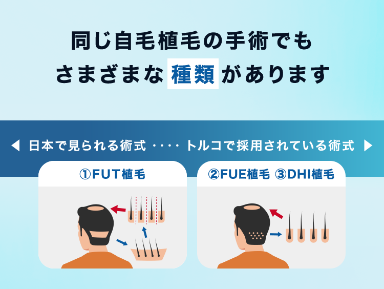 同じ自毛植毛の手術でもさまざまな種類があります