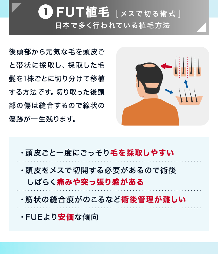 FUT植毛（メスで切る術式）日本で多く行われている植毛方法